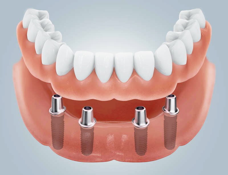 Doppelkronen auf Implantaten