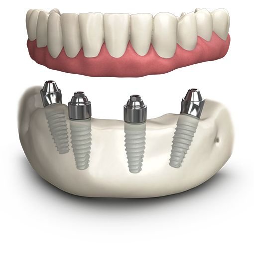 Prothese auf Implantaten